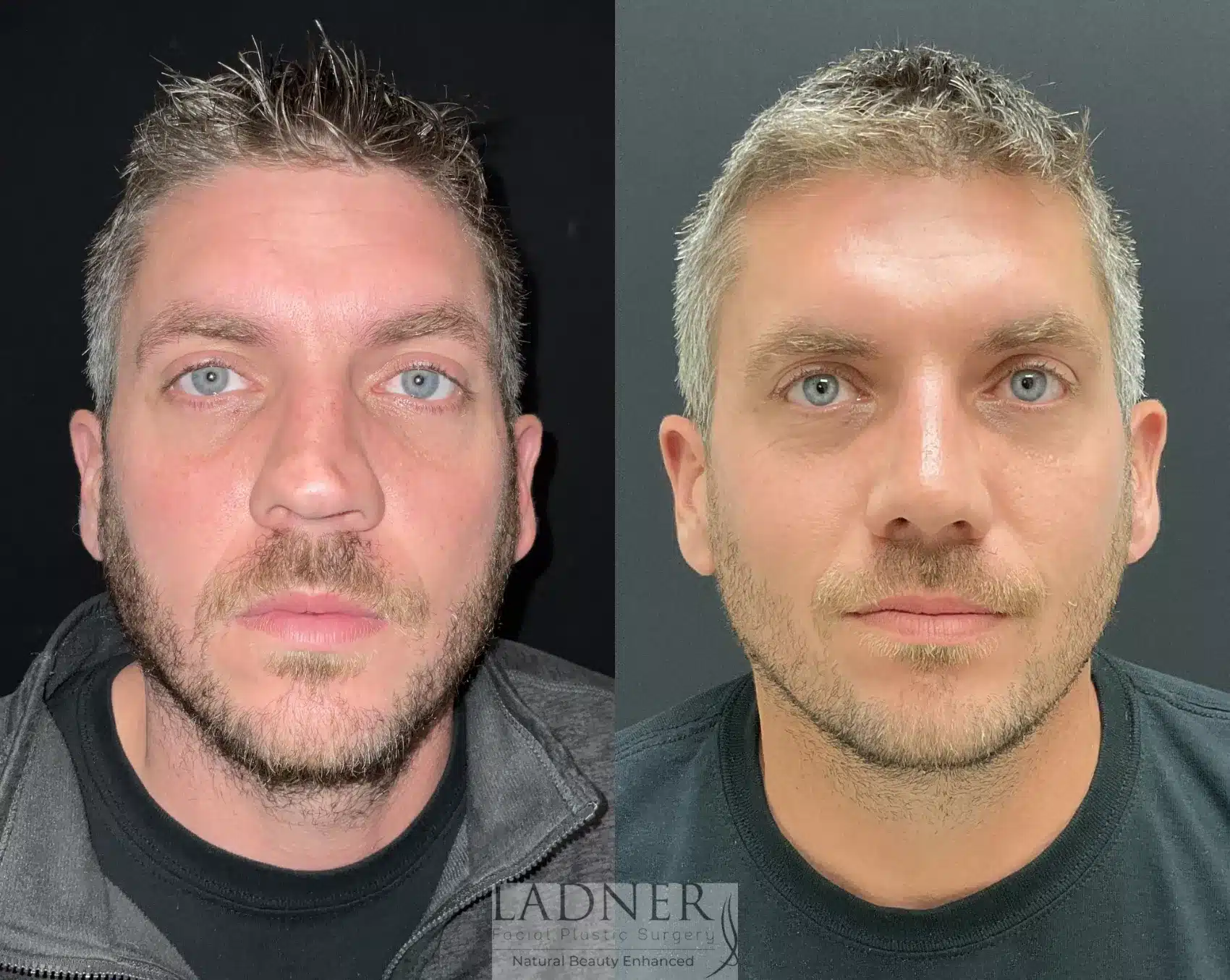 Before and After Image: Rhinoplasty - front