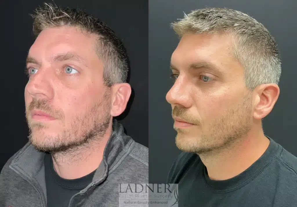 Before and After Image: Rhinoplasty & Facial Plastic Surgery for Men - left-front-oblique