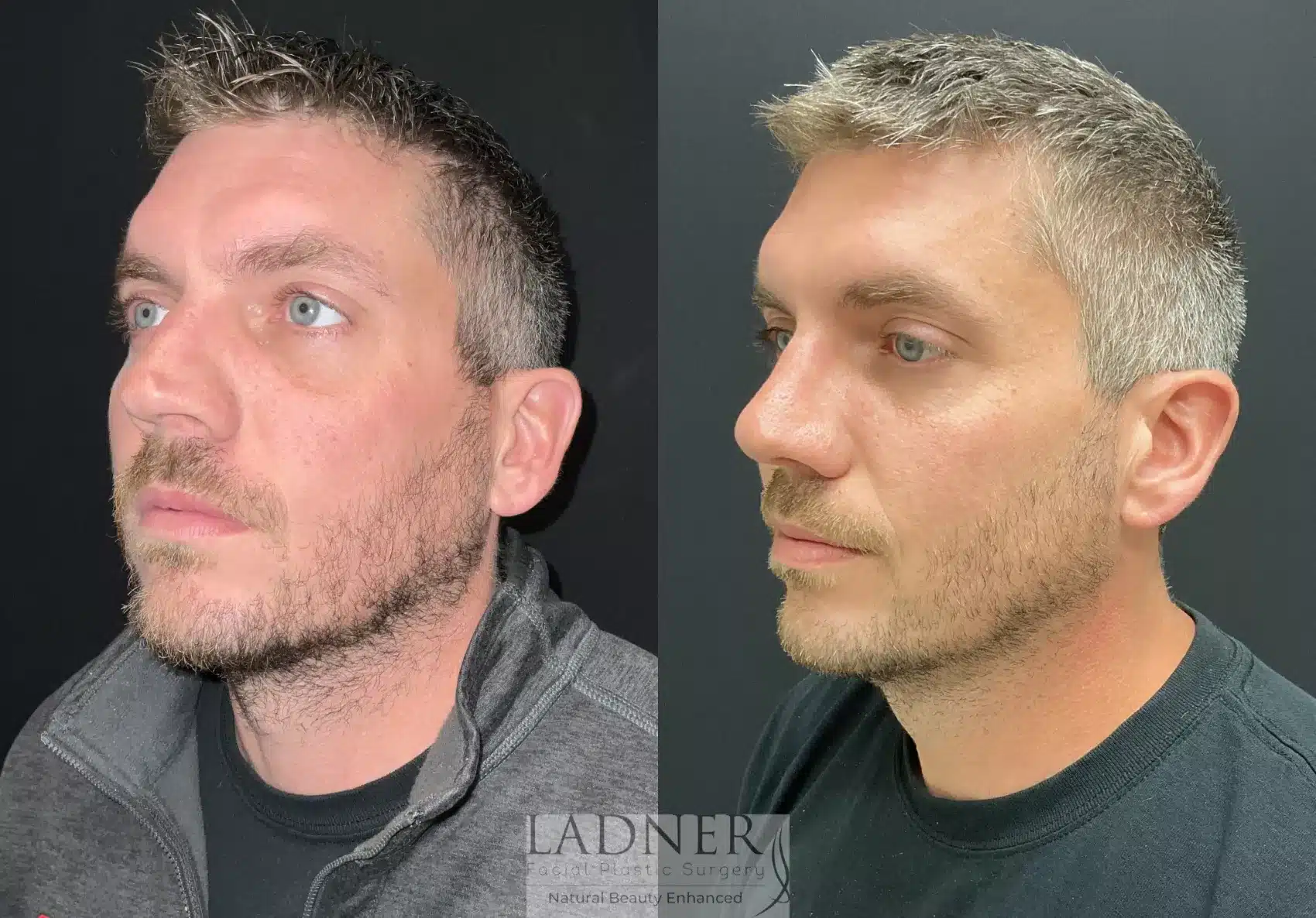 Before and After Image: Rhinoplasty - left-front-oblique
