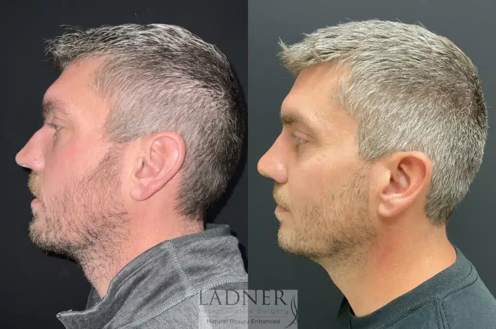 Before and After Image: Rhinoplasty & Facial Plastic Surgery for Men - left-side