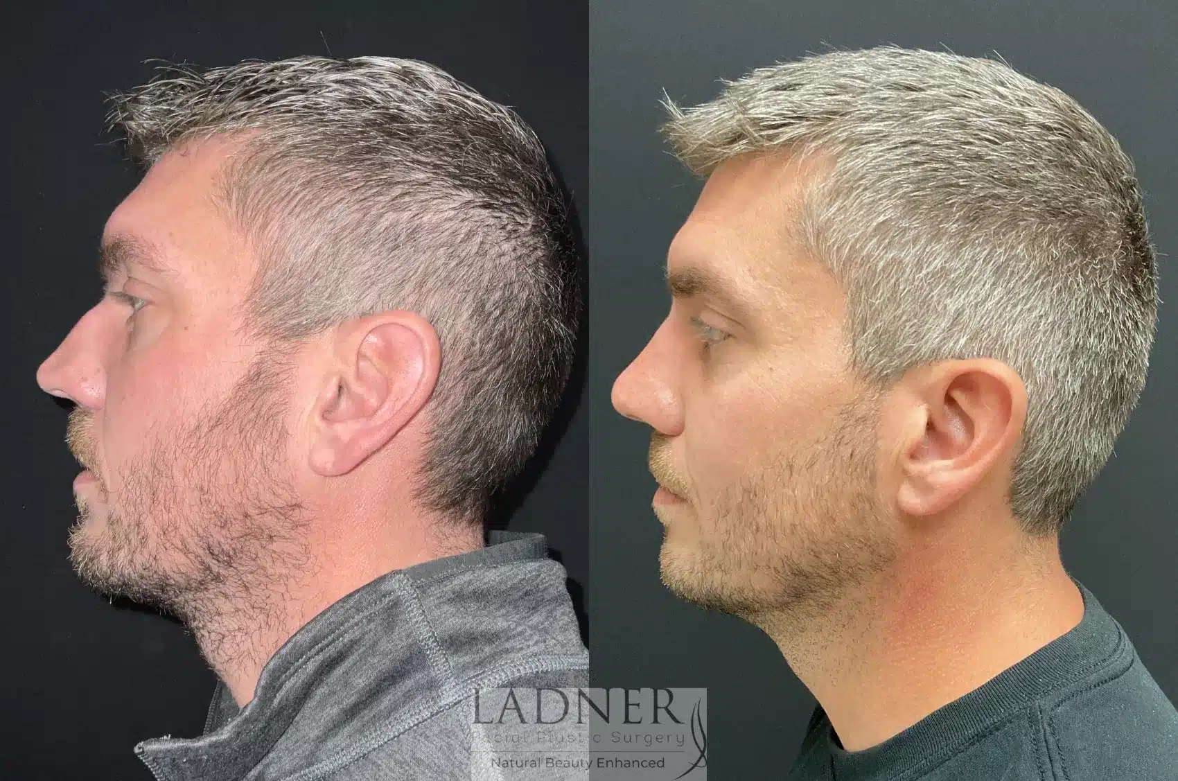 Before and After Image: Rhinoplasty - left-side