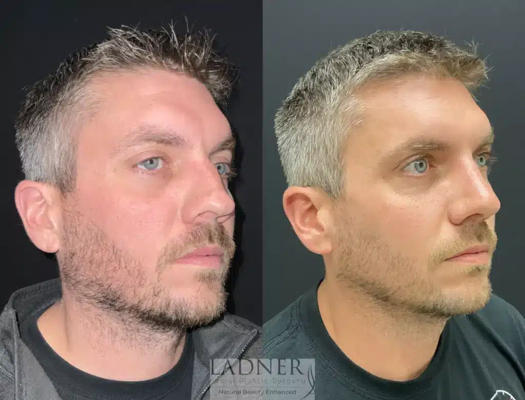 Before and After Image: Rhinoplasty & Facial Plastic Surgery for Men - right-front-oblique