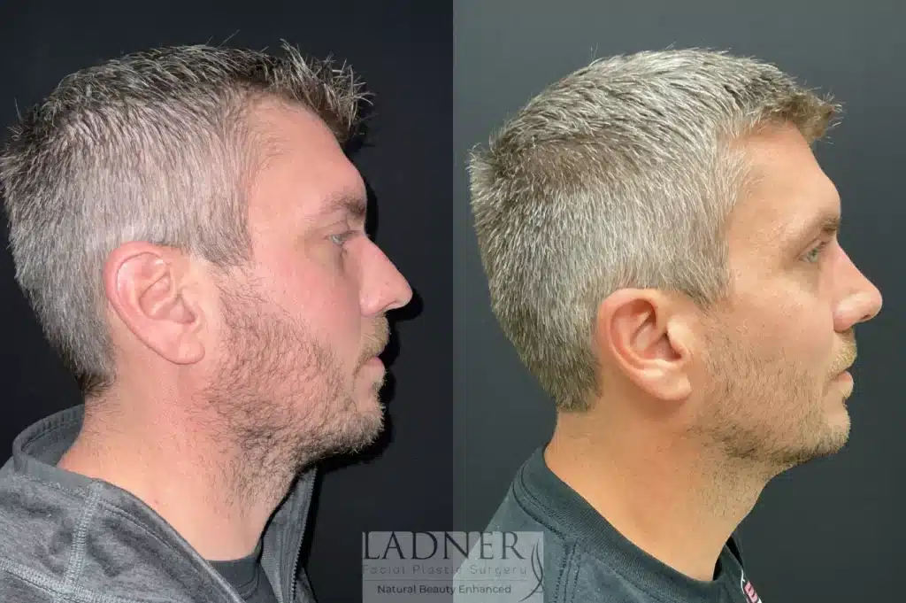 Before and After Image: Rhinoplasty & Facial Plastic Surgery for Men - right-side