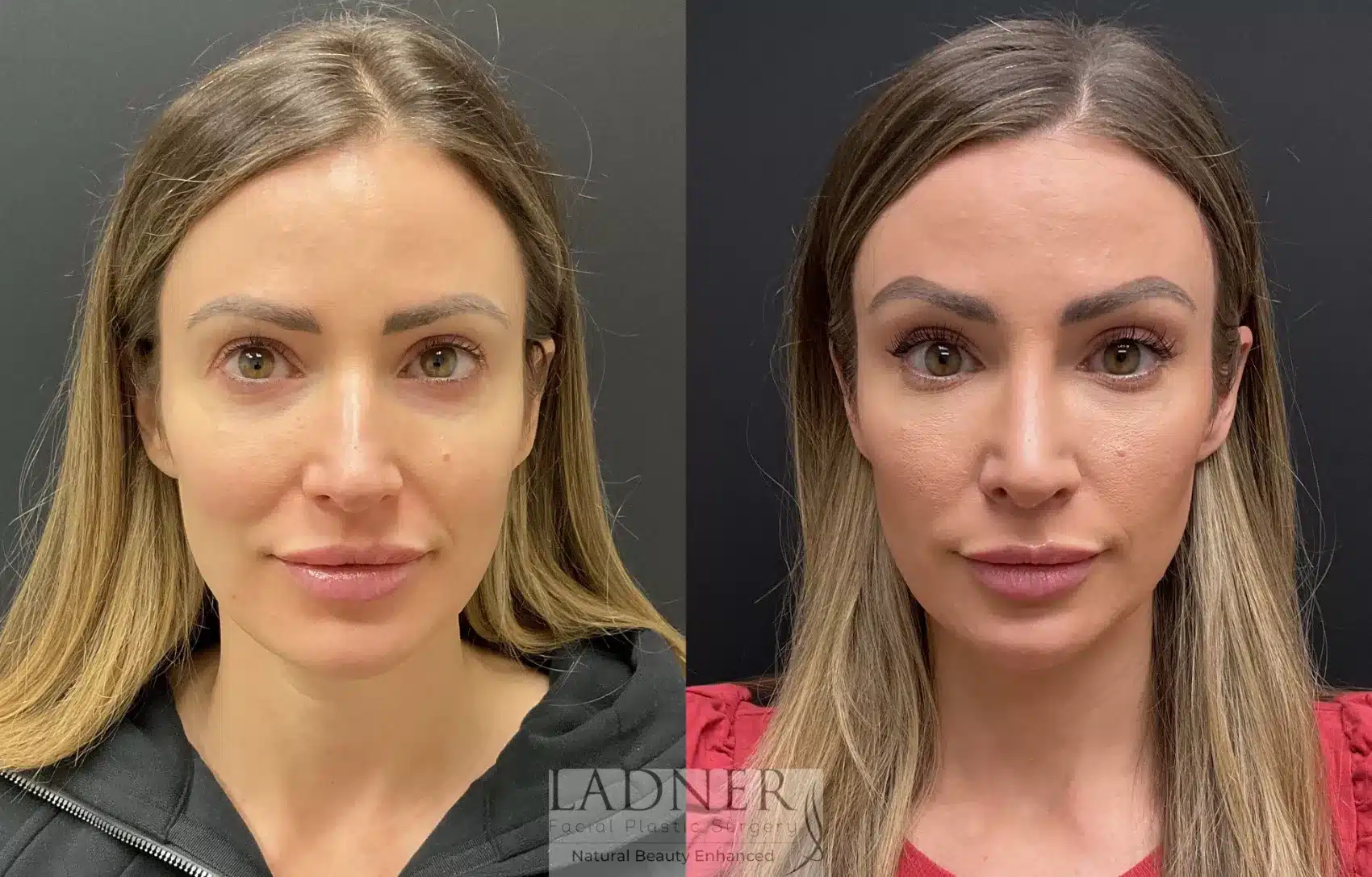Before and After Image: Rhinoplasty - front