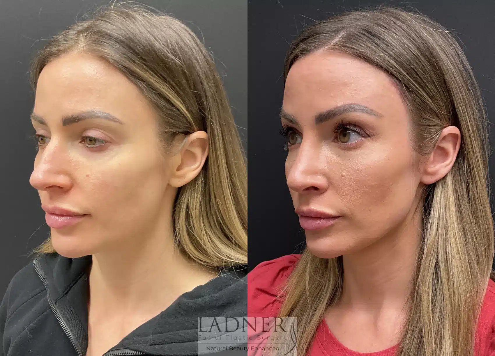 Before and After Image: Rhinoplasty - left-front-oblique