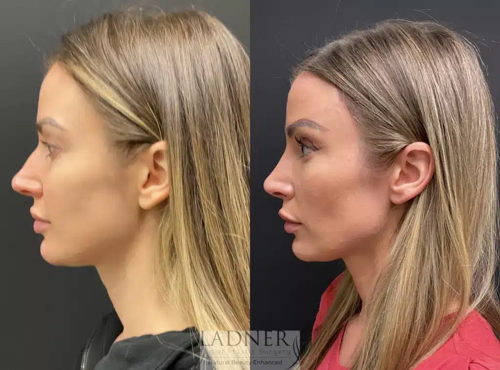 Before and After Image: Rhinoplasty - left-side