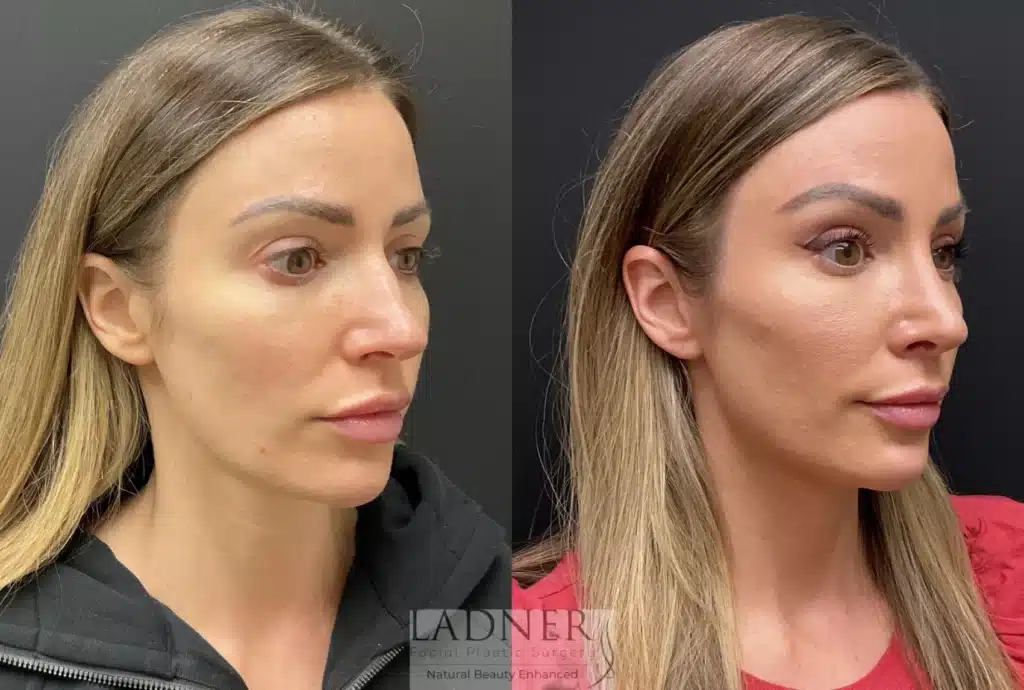 Before and After Image: Rhinoplasty - right-front-oblique