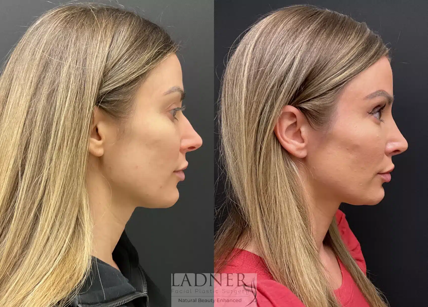 Before and After Image: Rhinoplasty - right-side