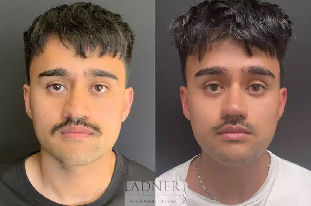 Before and After Image: Rhinoplasty - front
