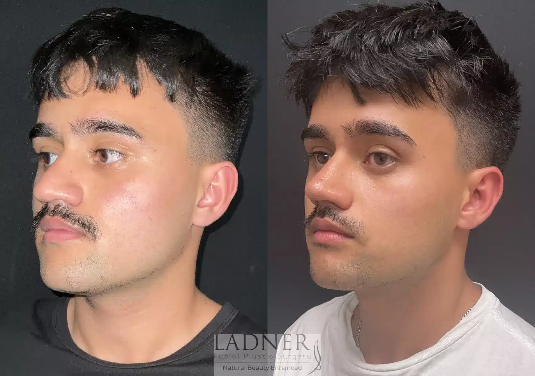 Before and After Image: Rhinoplasty - left-front-oblique