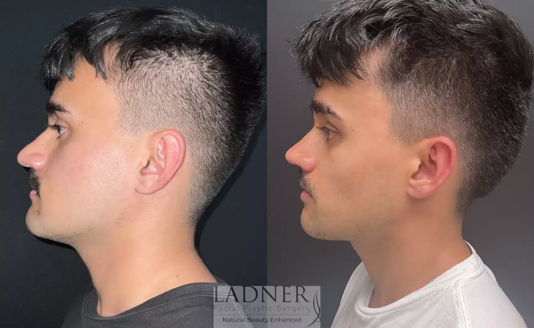 Before and After Image: Rhinoplasty - left-side