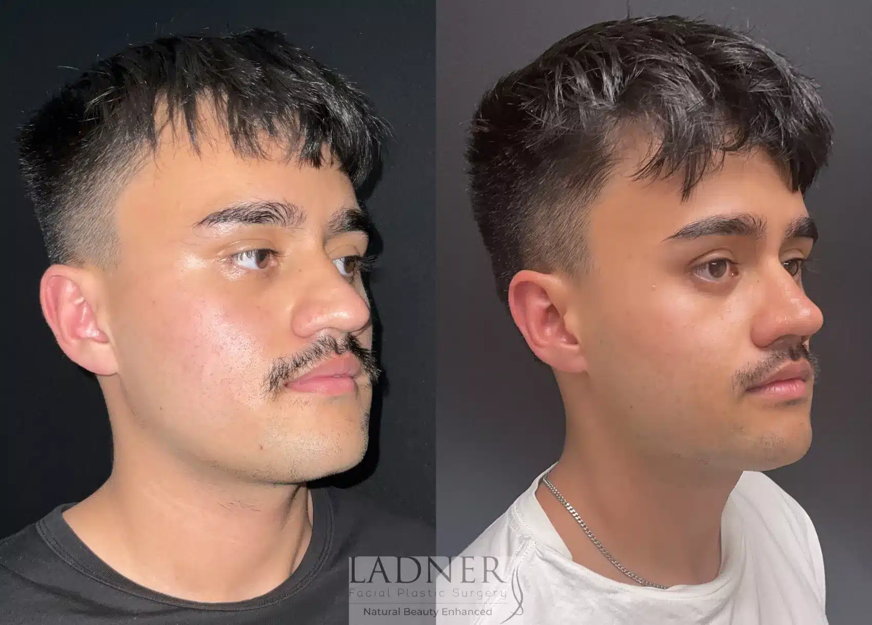 Before and After Image: Rhinoplasty - right-front-oblique