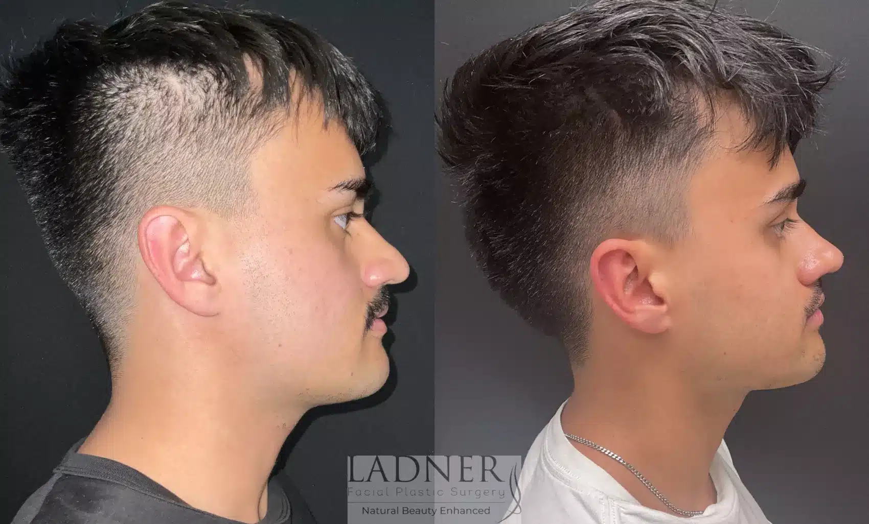 Before and After Image: Rhinoplasty - right-side