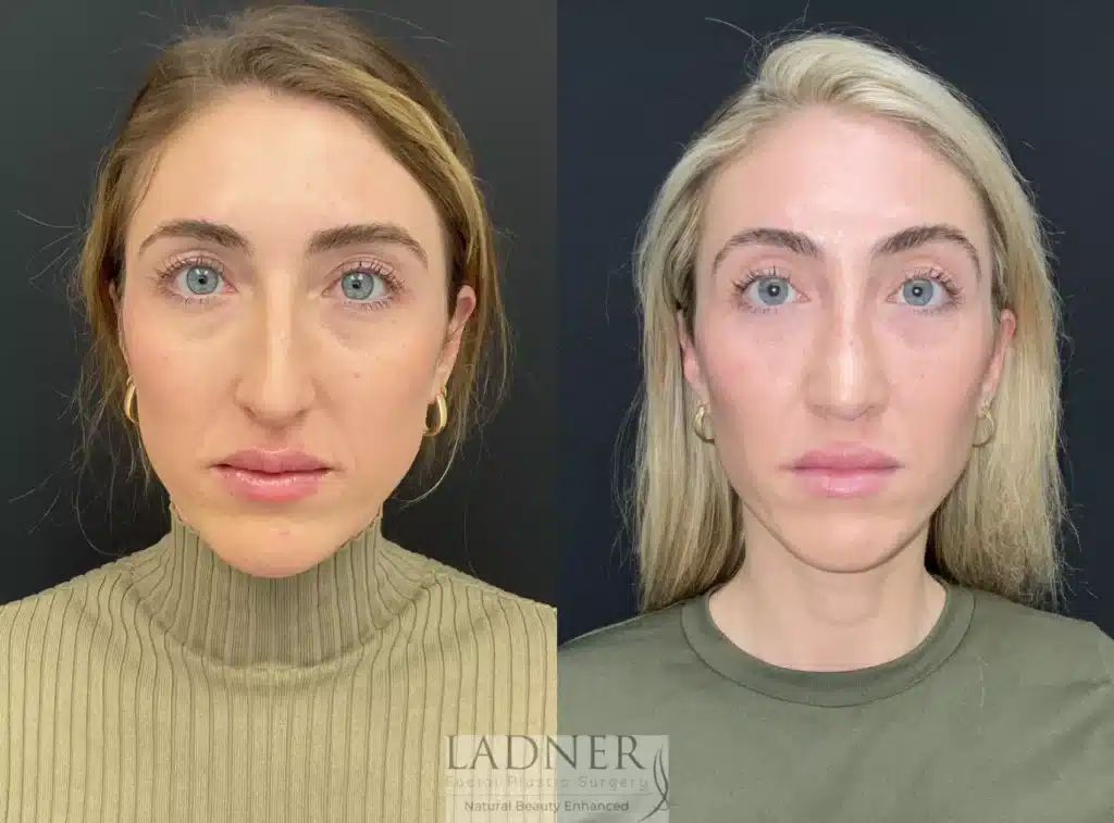 Before and After Image: Rhinoplasty - front
