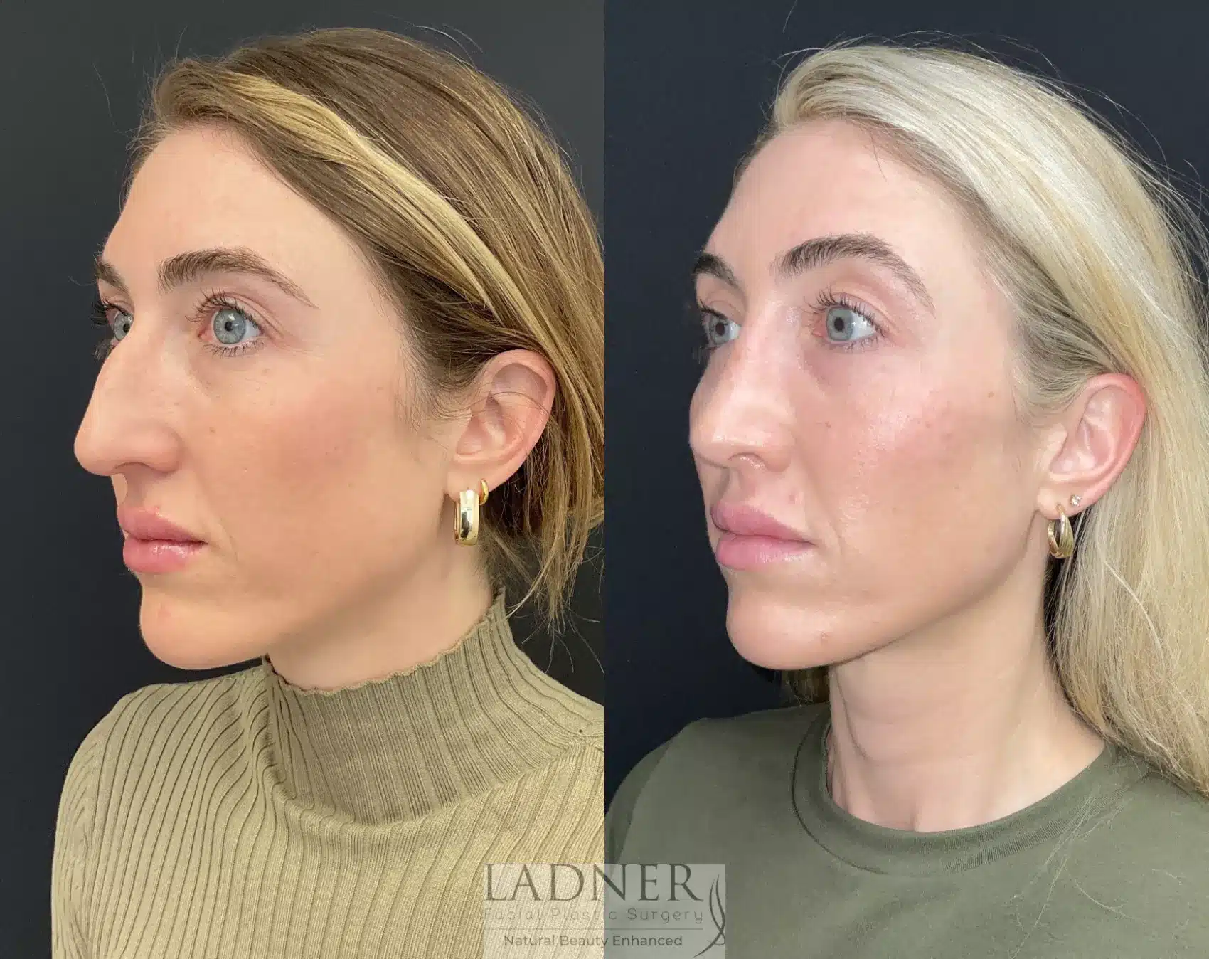Before and After Image: Rhinoplasty - left-front-oblique
