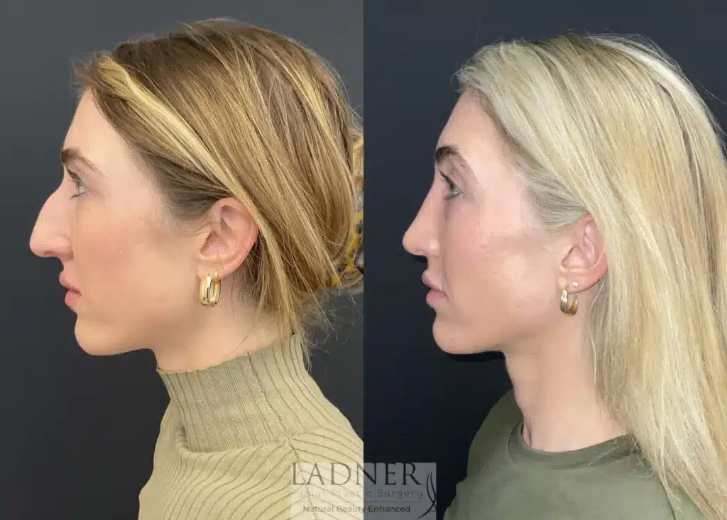 Before and After Image: Rhinoplasty - left-side