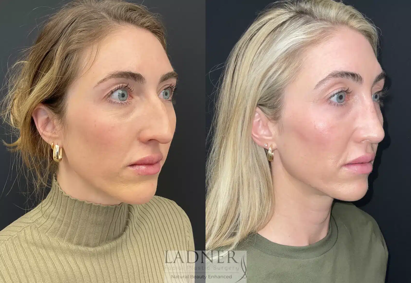 Before and After Image: Rhinoplasty - right-front-oblique
