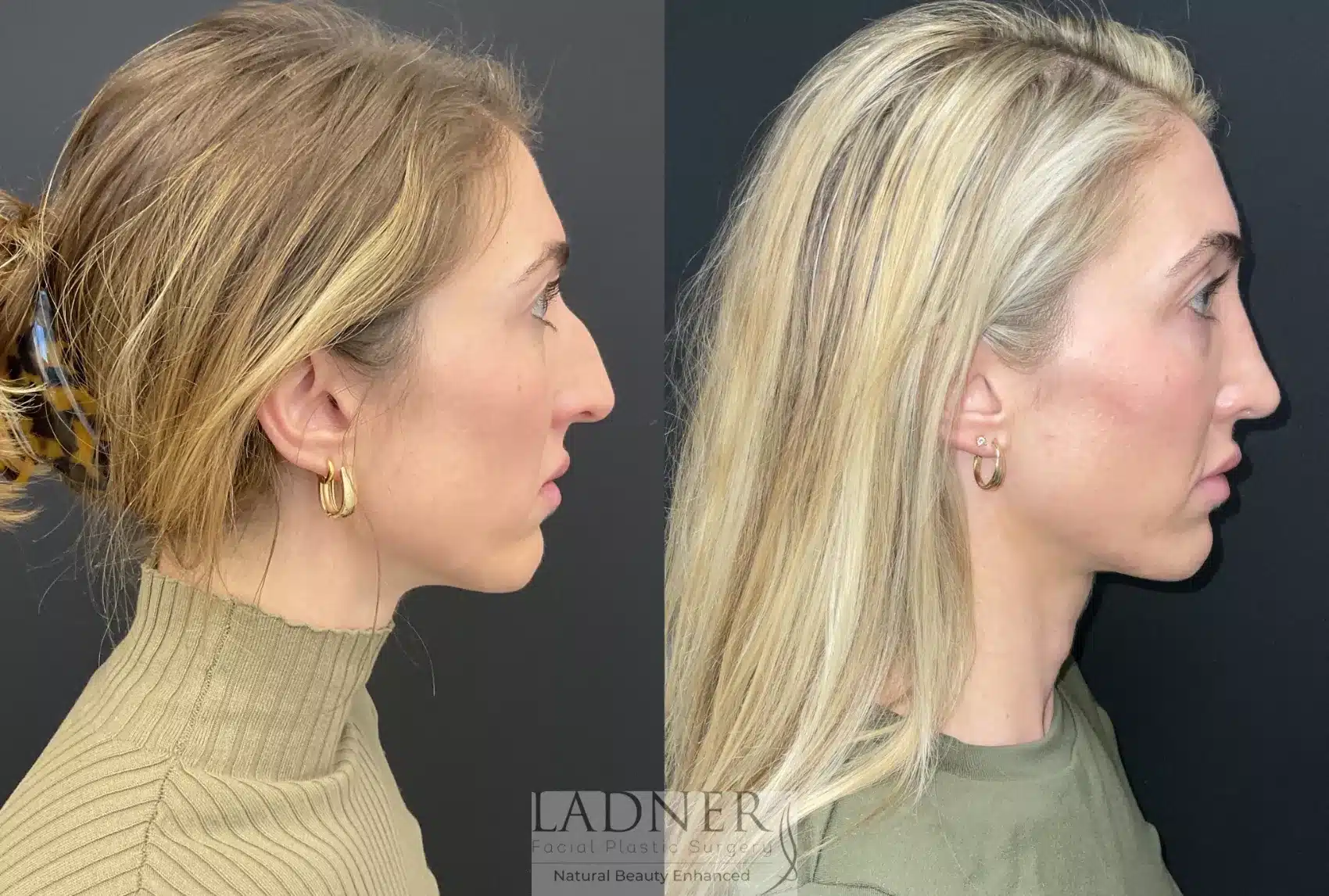 Before and After Image: Rhinoplasty - right-side