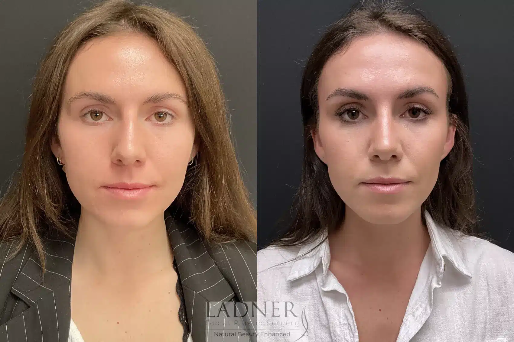 Before and After Image: Rhinoplasty - front