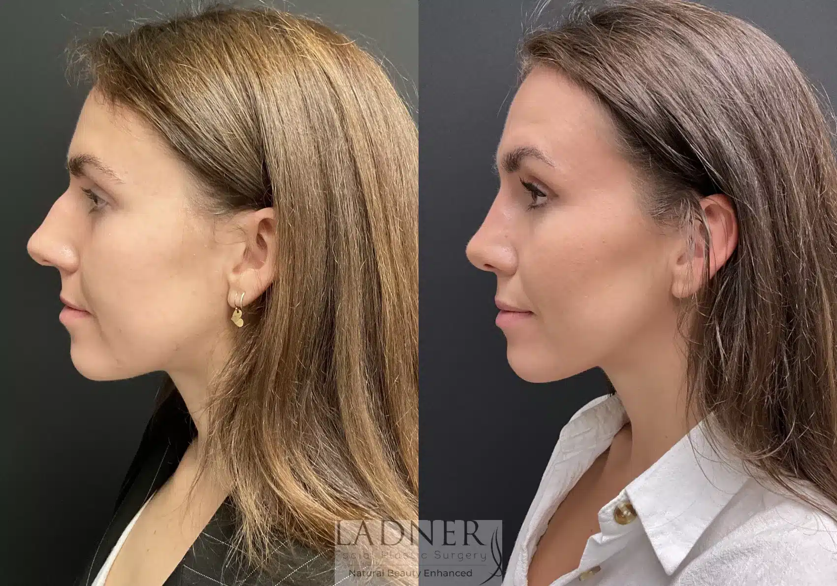 Before and After Image: Rhinoplasty - left-side