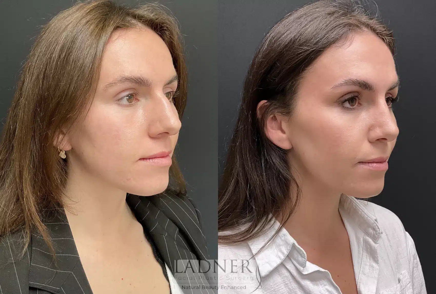 Before and After Image: Rhinoplasty - right-front-oblique