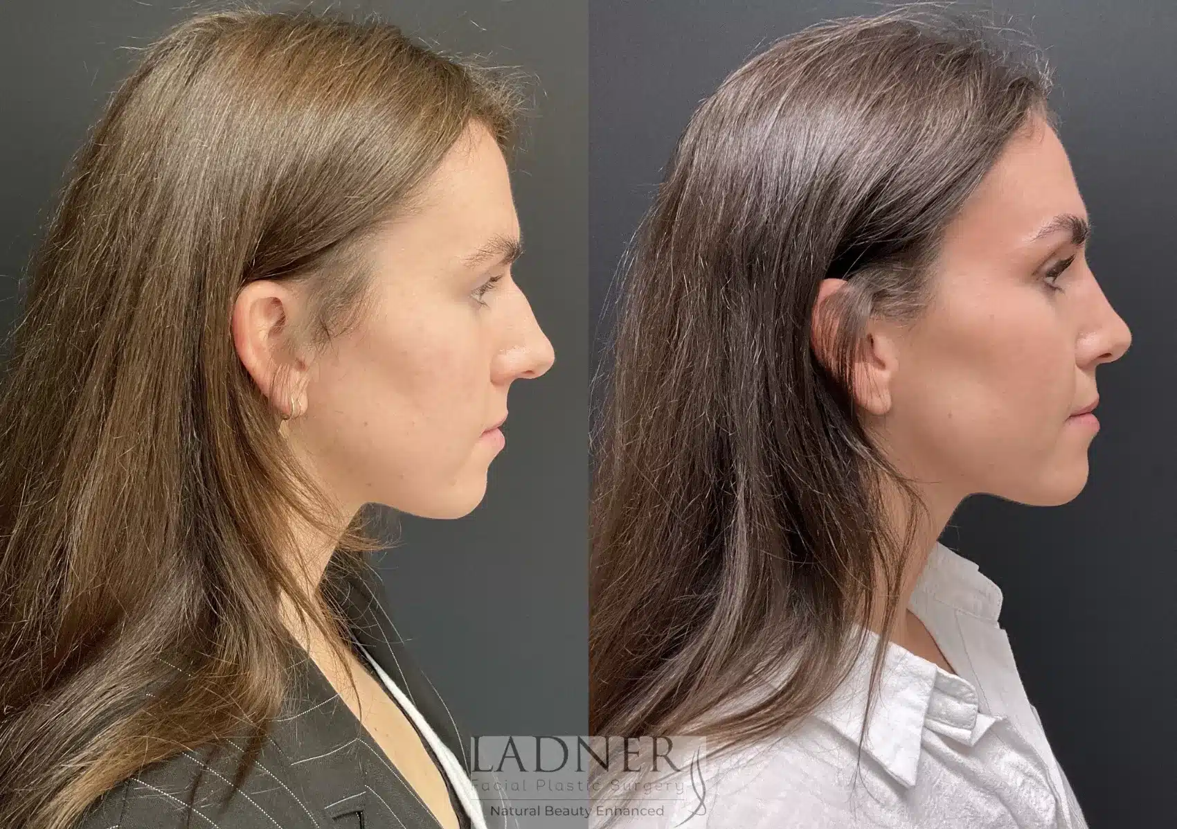 Before and After Image: Rhinoplasty - right-side