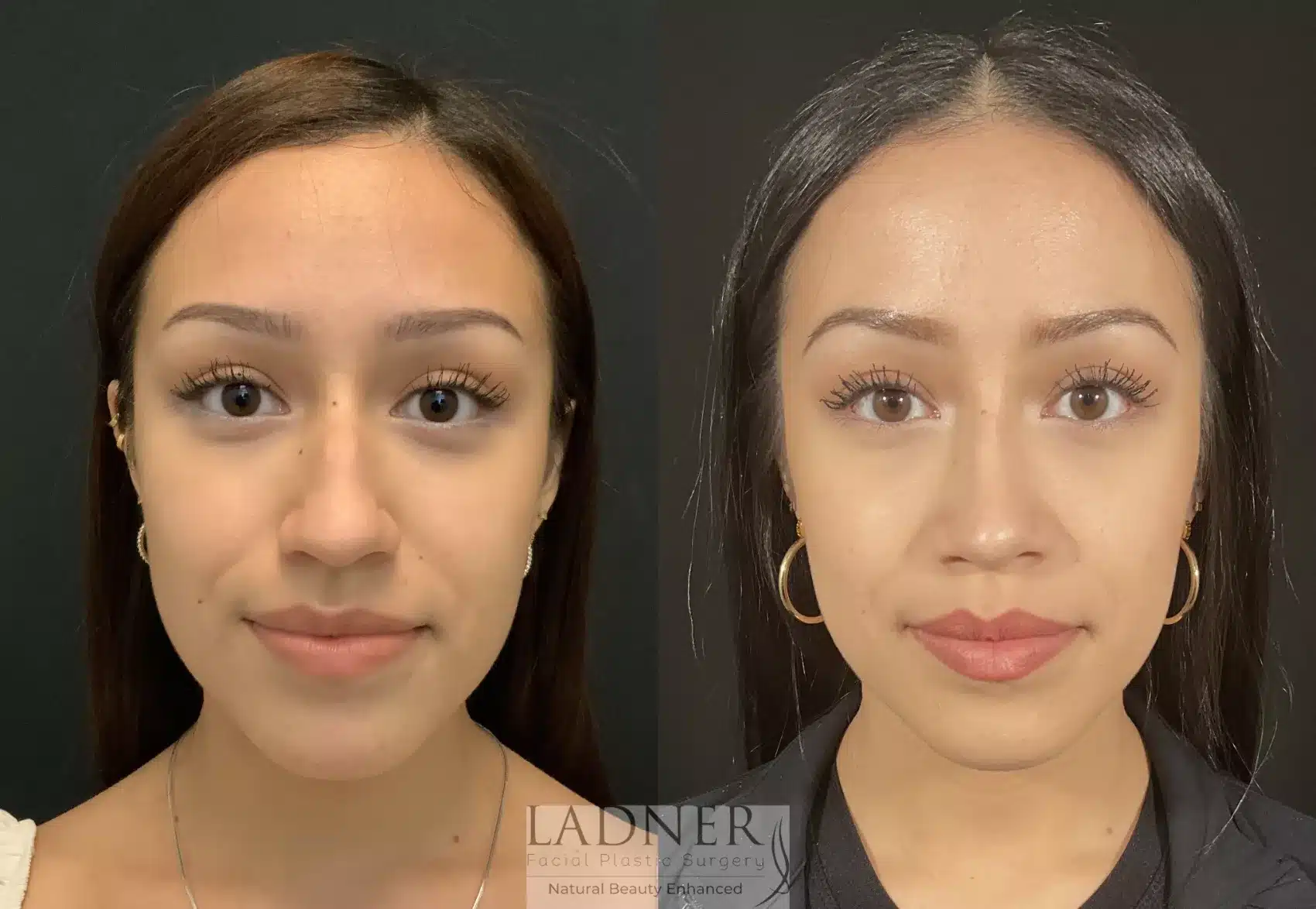 Before and After Image: Rhinoplasty - front