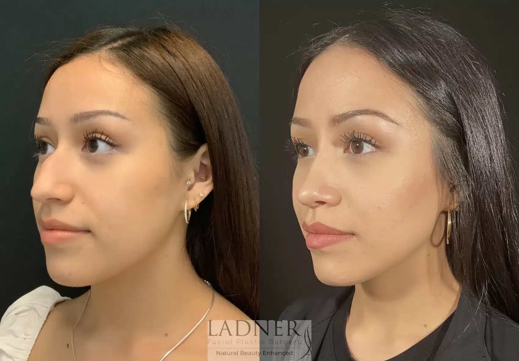 Before and After Image: Rhinoplasty - left-front-oblique