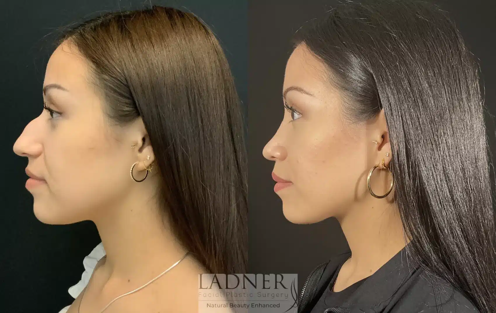 Before and After Image: Rhinoplasty - left-side
