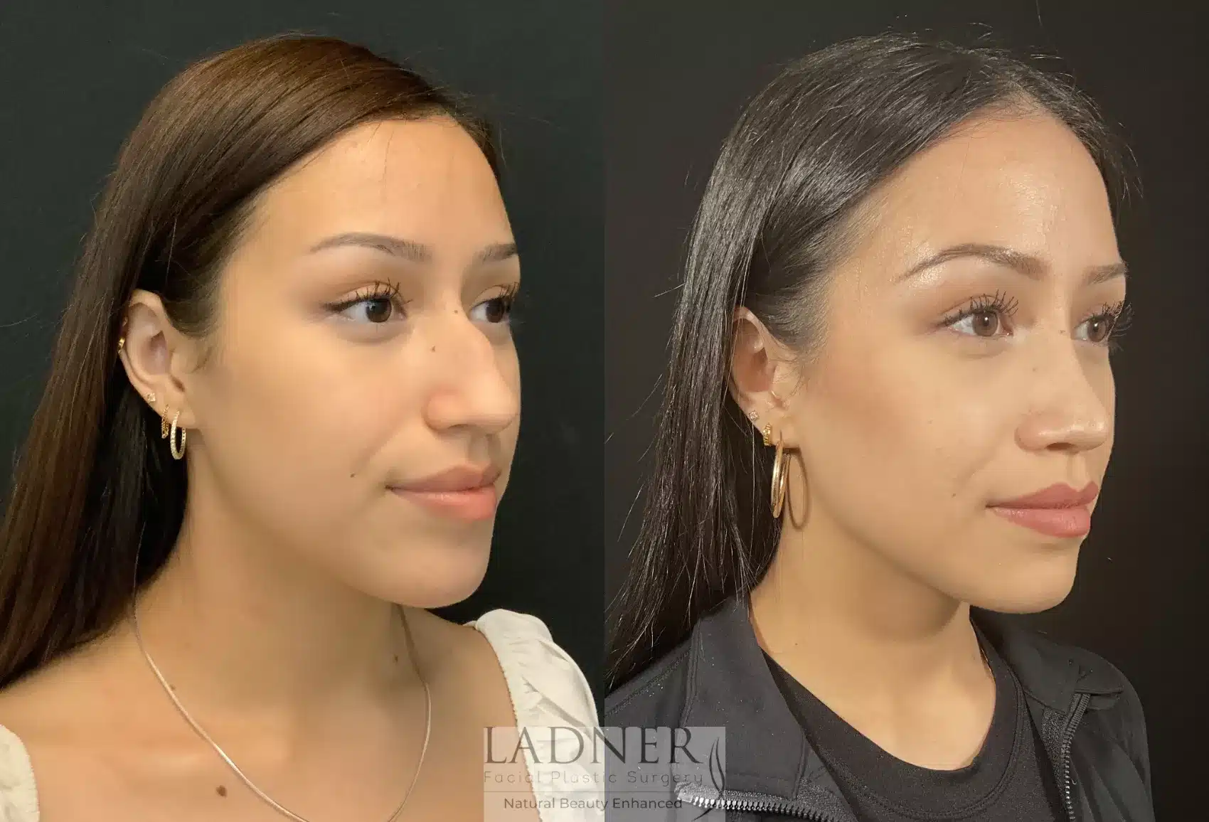 Before and After Image: Rhinoplasty - right-front-oblique