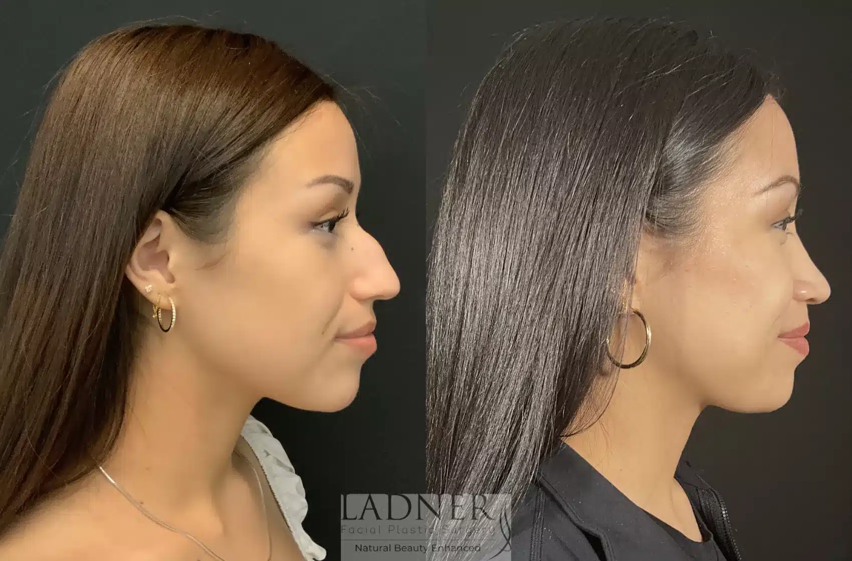 Before and After Image: Rhinoplasty - right-side