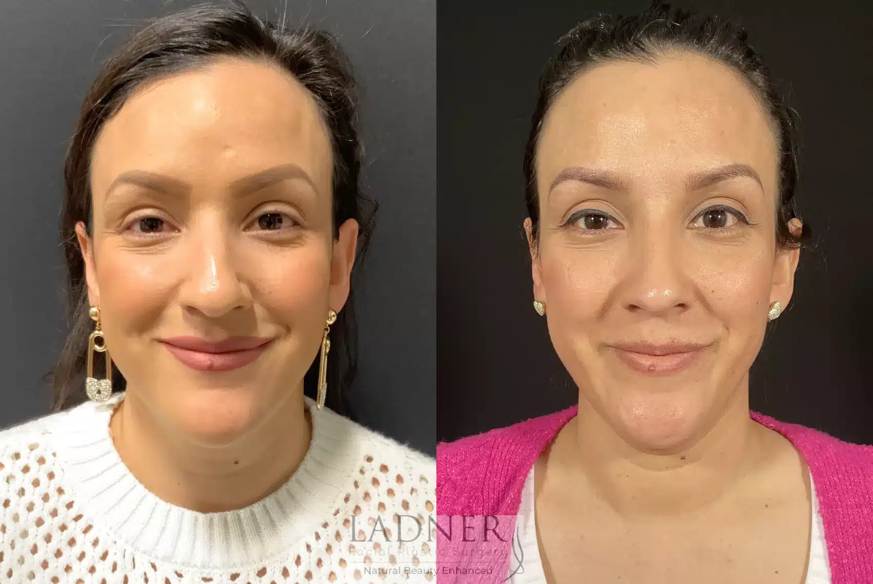 Before and After Image: Rhinoplasty - front