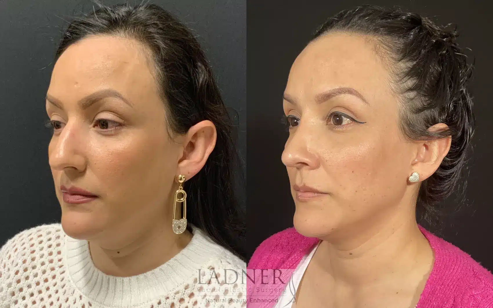 Before and After Image: Rhinoplasty - left-front-oblique