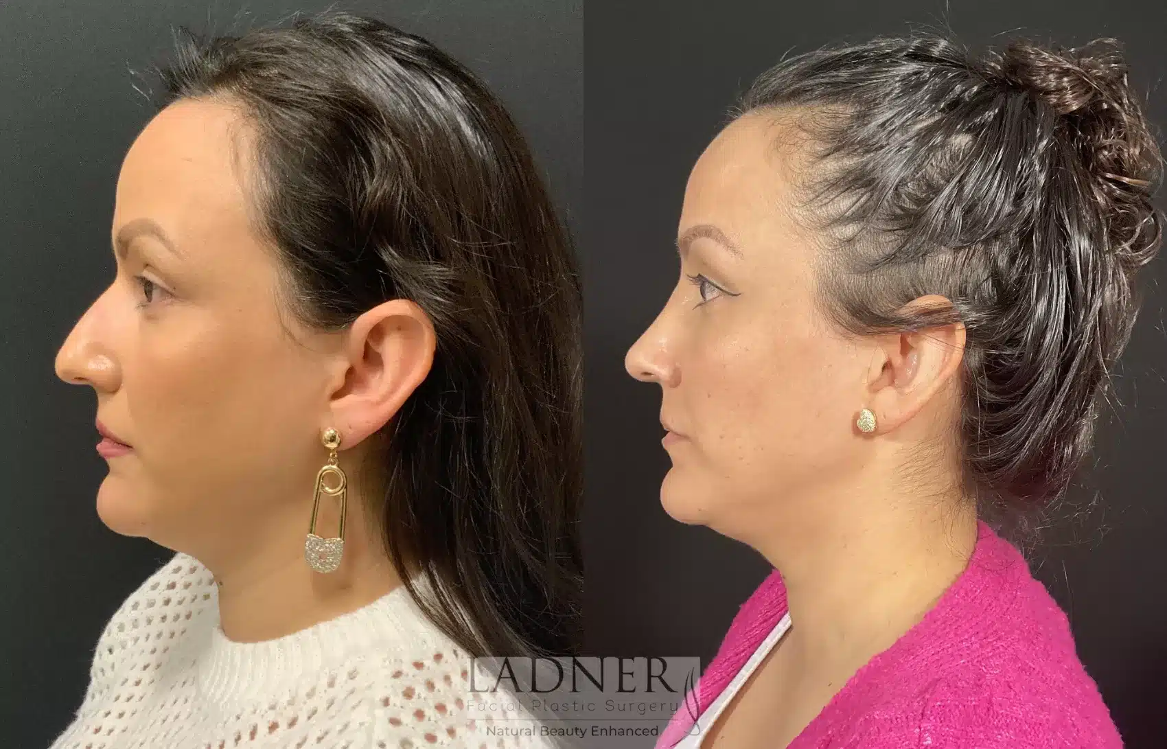 Before and After Image: Rhinoplasty - left-side
