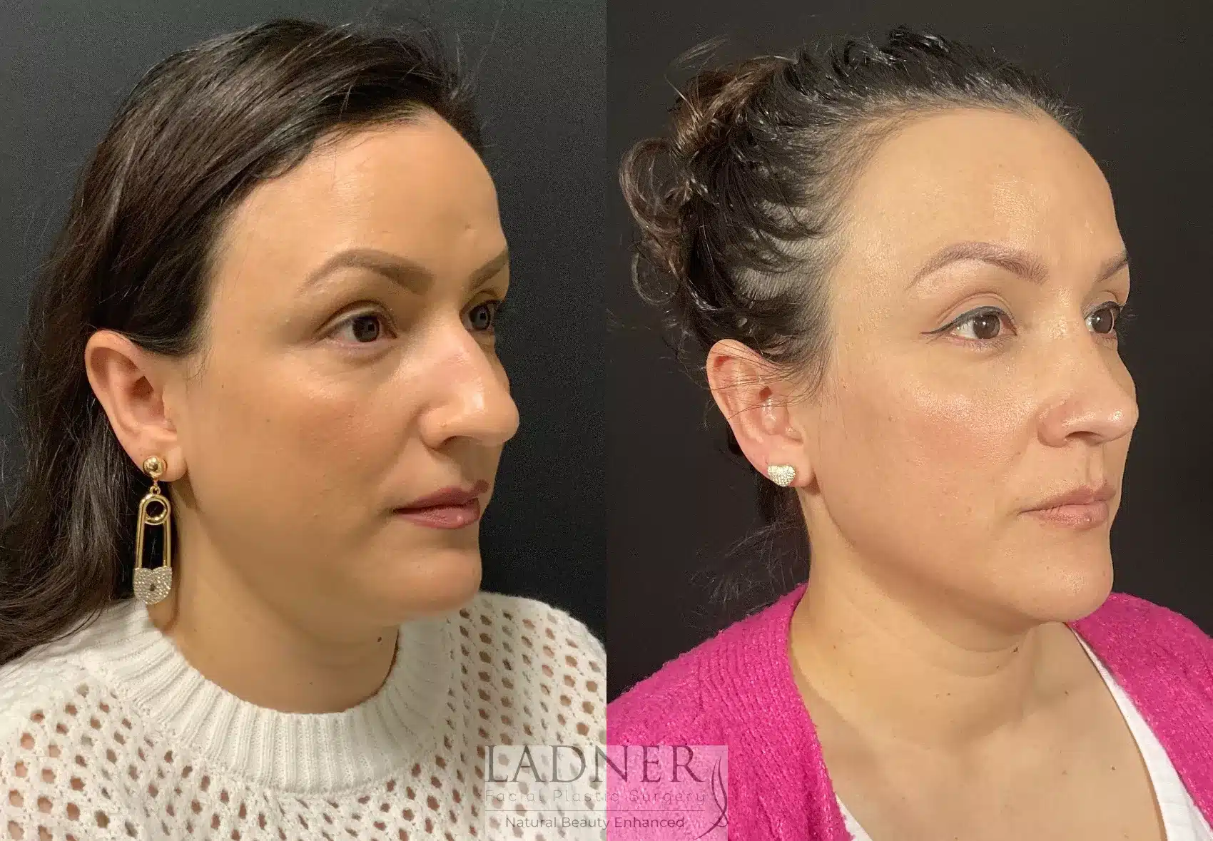 Before and After Image: Rhinoplasty - right-front-oblique