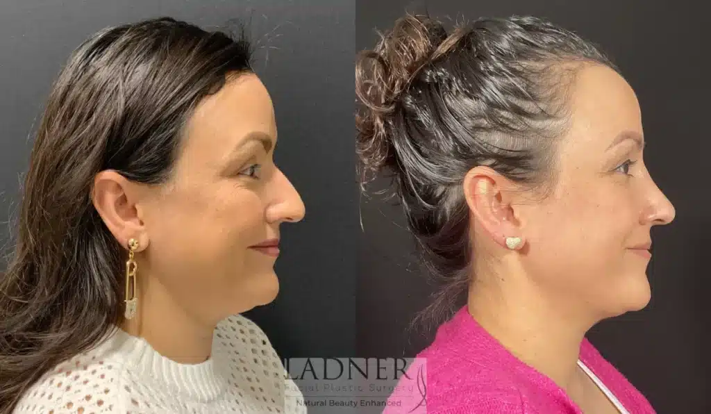 Before and After Image: Rhinoplasty - right-side
