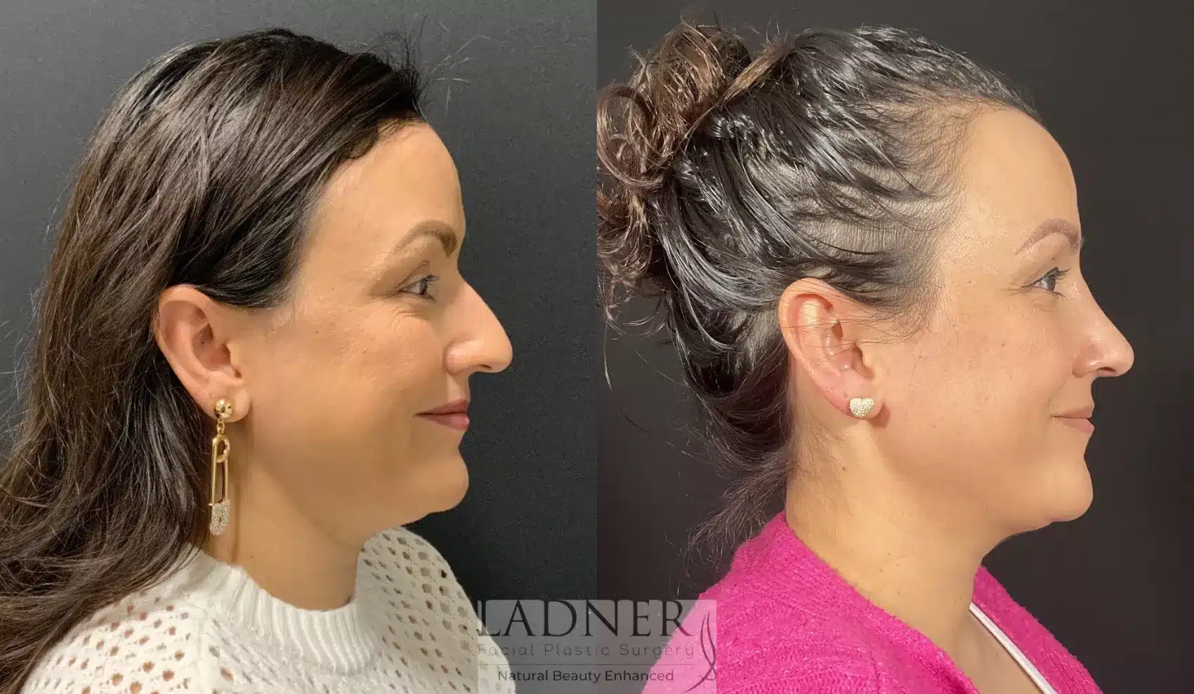 Before and After Image: Rhinoplasty - right-side