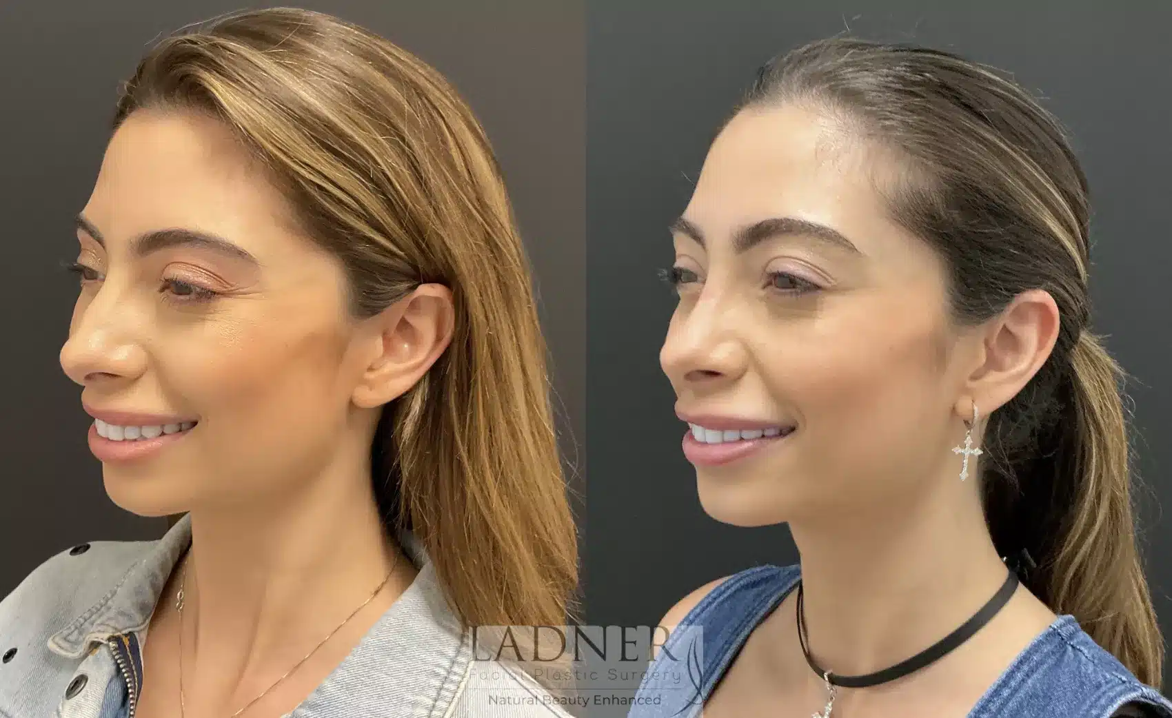 Before and After Image: Rhinoplasty - left-front-oblique
