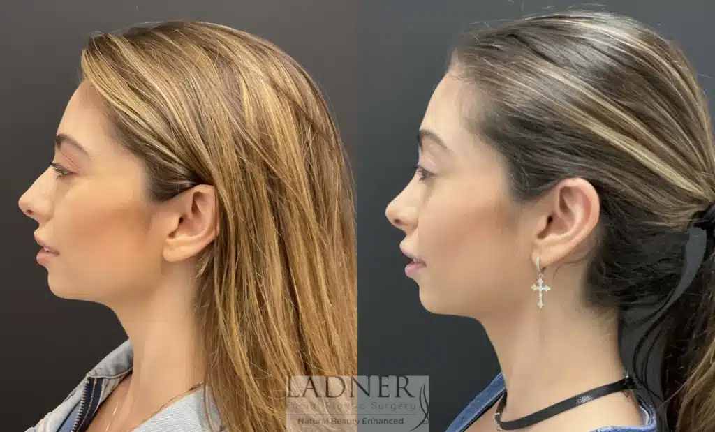 Before and After Image: Botox/Dysport - left-side