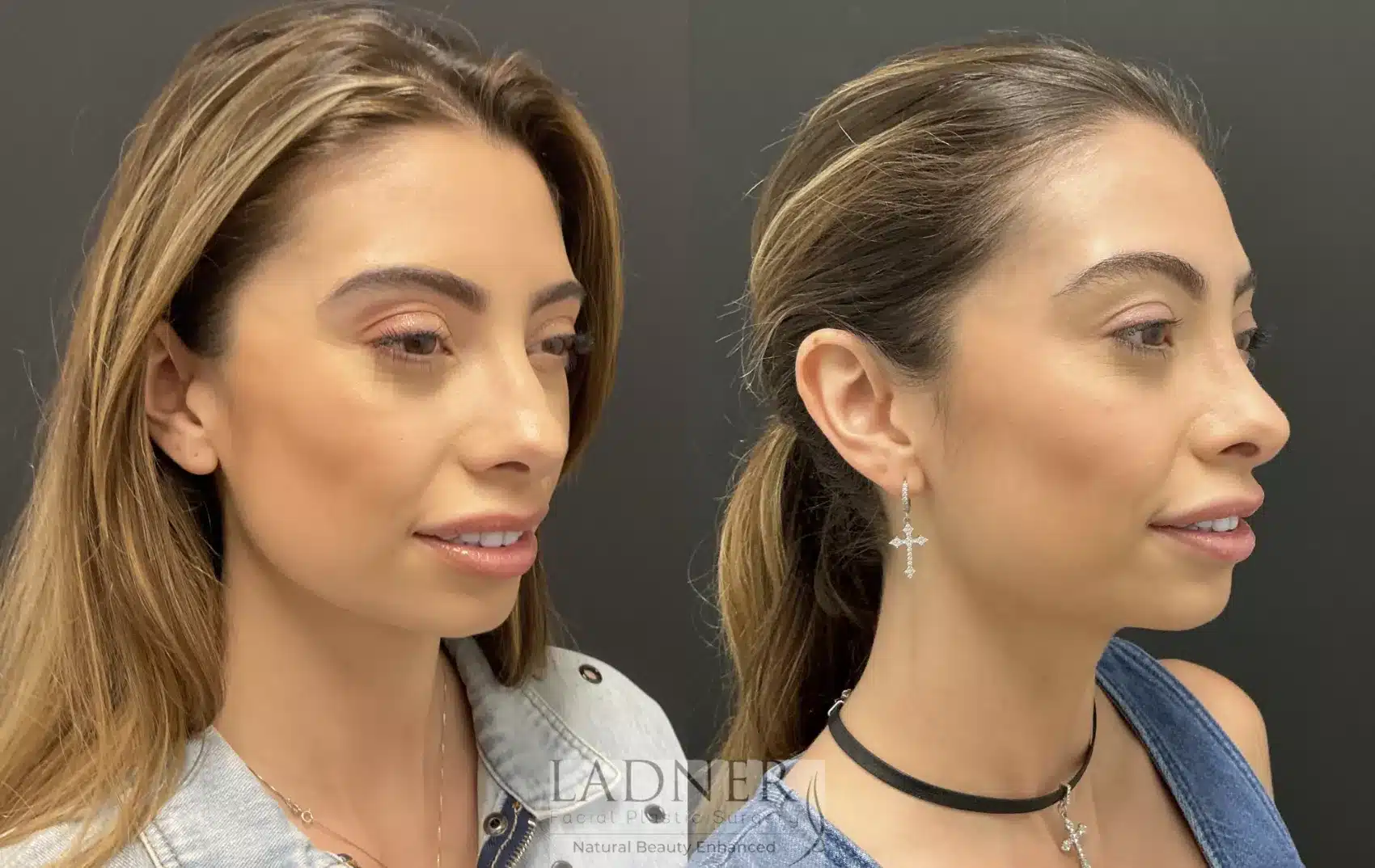 Before and After Image: Rhinoplasty - right-front-oblique