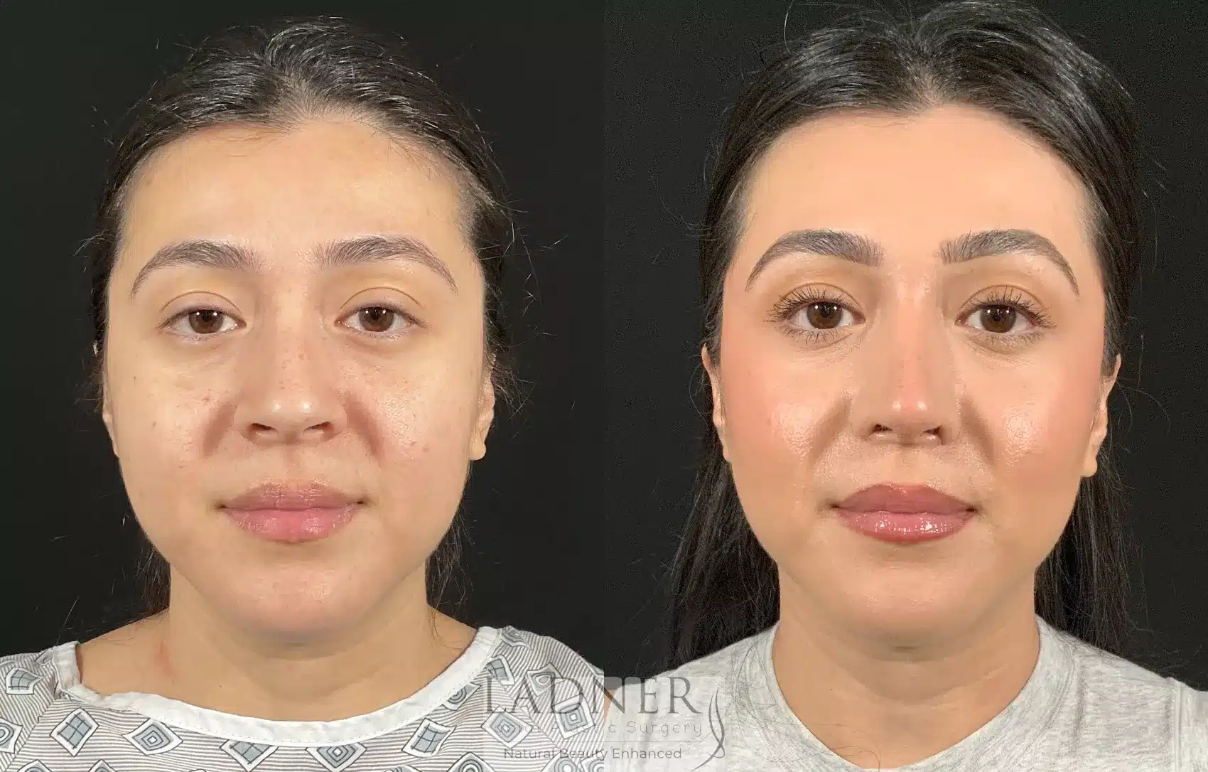 Before and After Image: Rhinoplasty - right-front-oblique