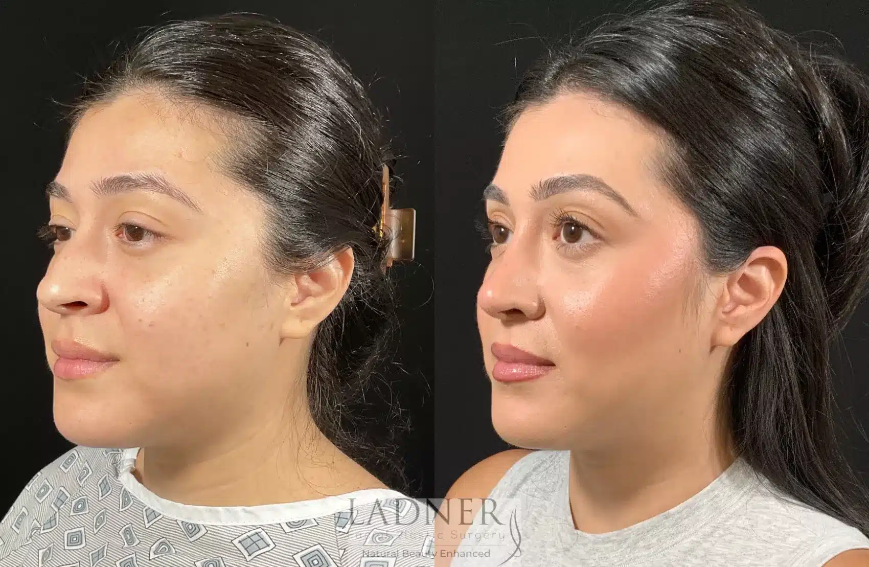 Before and After Image: Rhinoplasty - left-front-oblique
