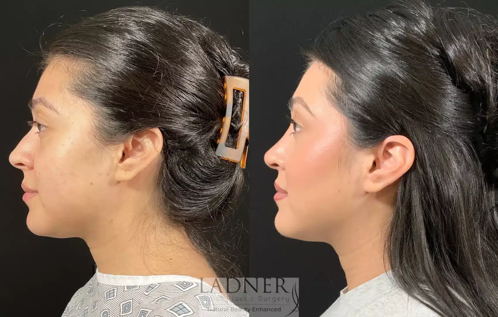 Before and After Image: Rhinoplasty - left-side