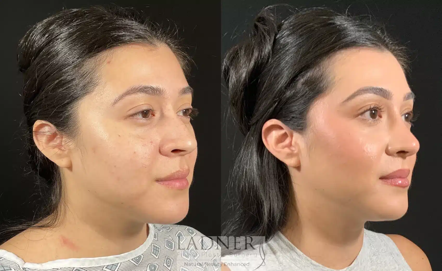 Before and After Image: Rhinoplasty - right-front-oblique