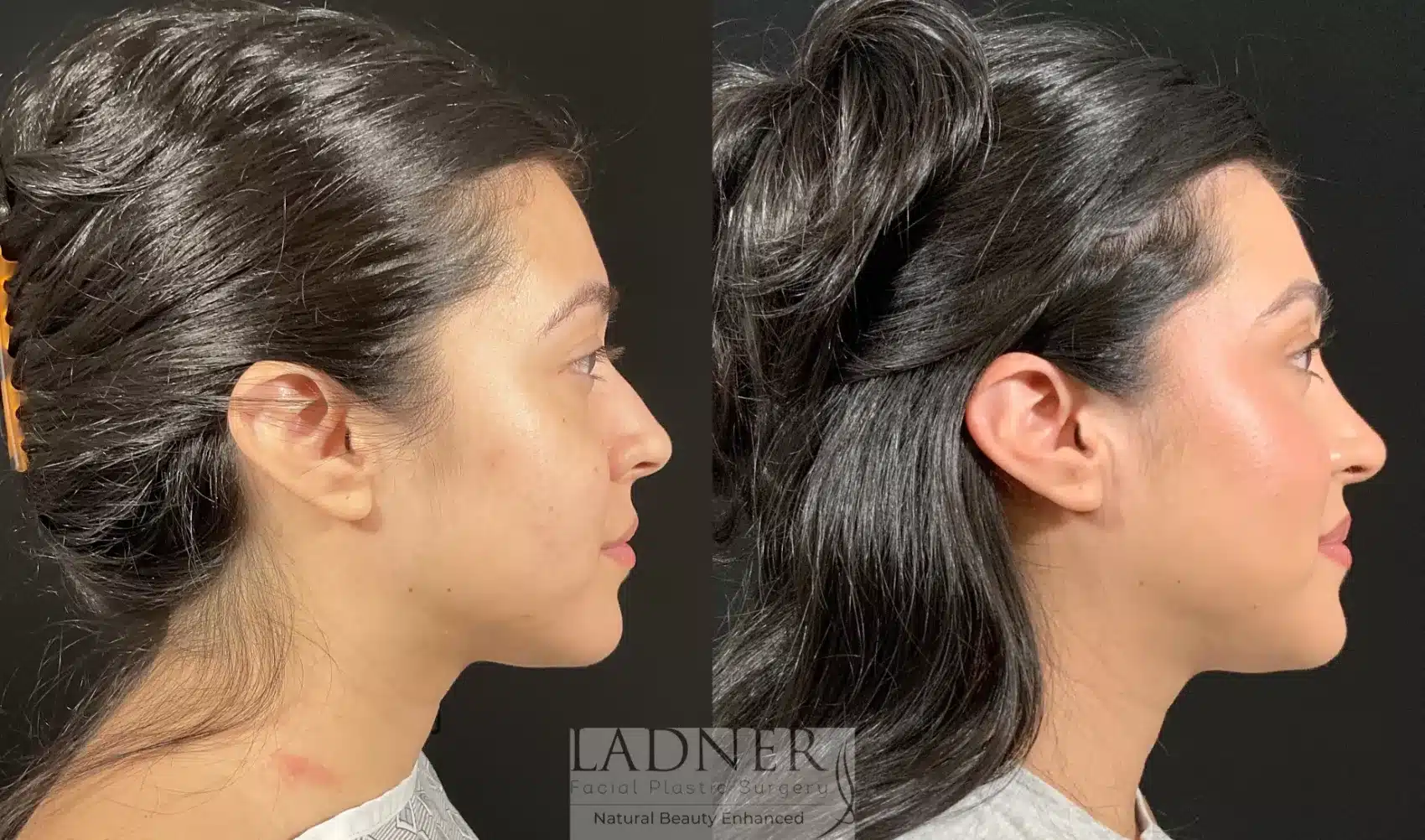 Before and After Image: Rhinoplasty - right-side