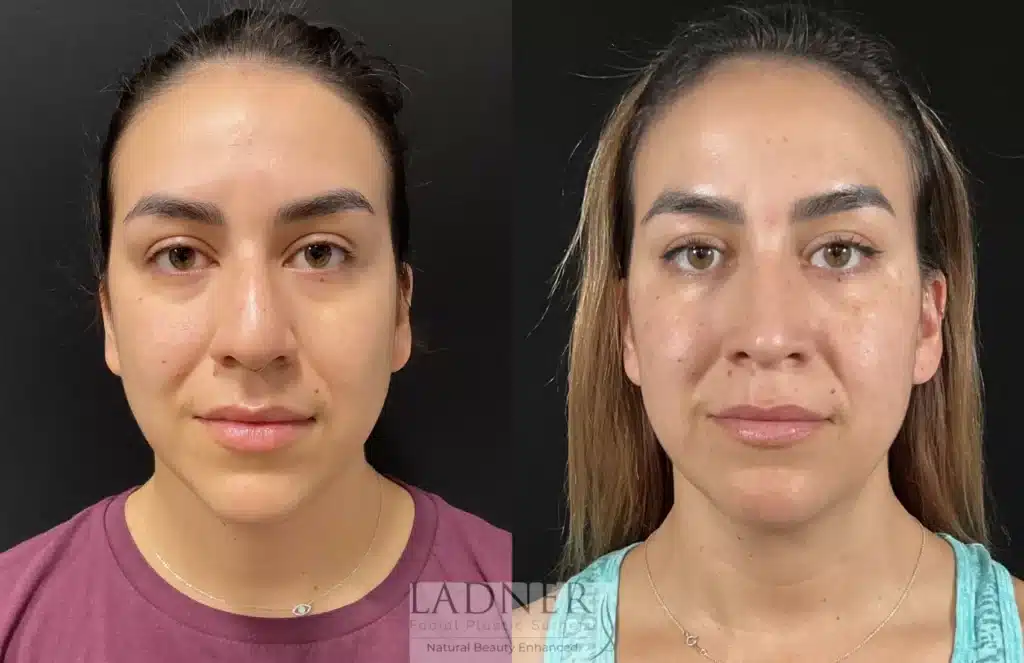 Before and After Image: Rhinoplasty - front