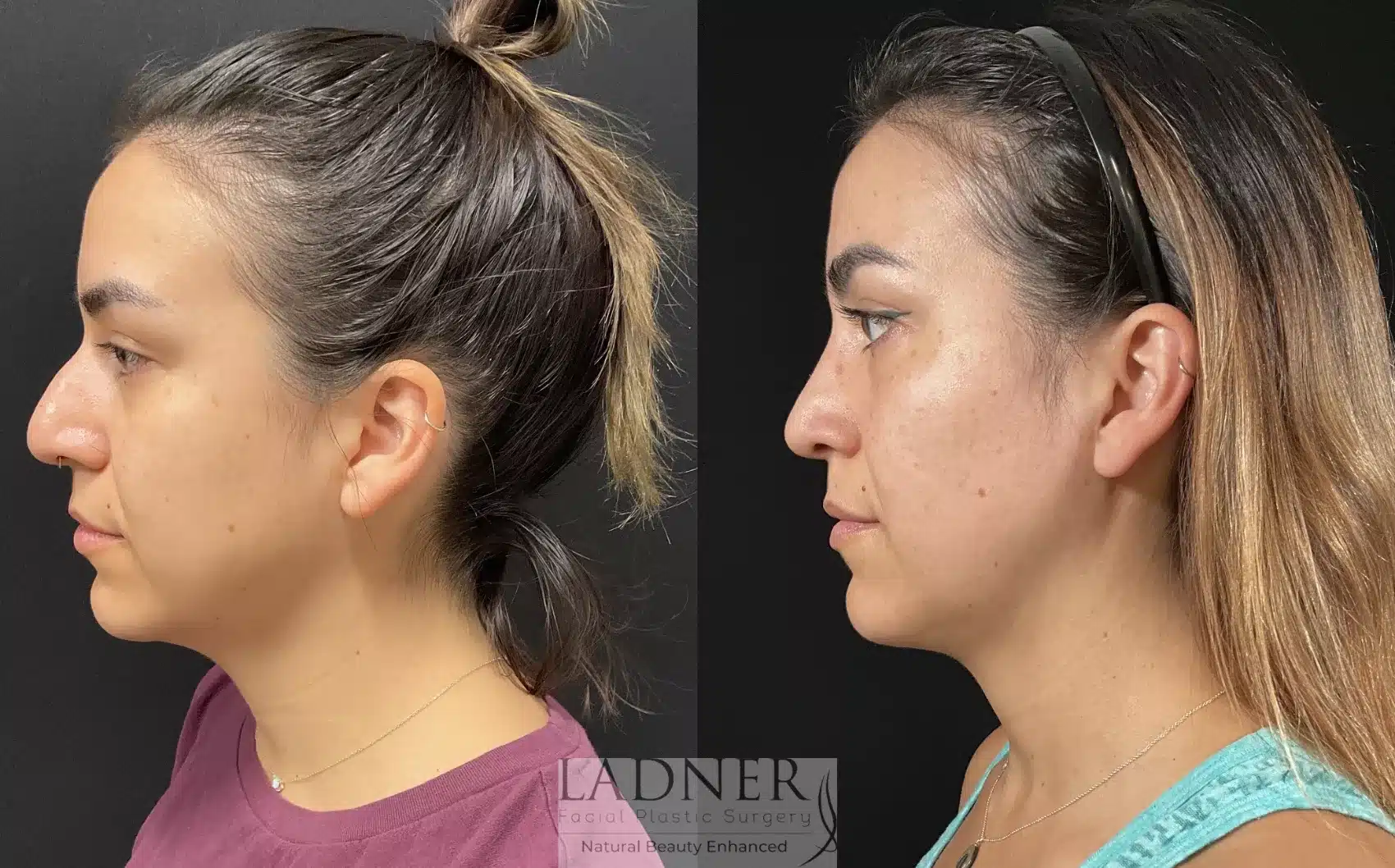 Before and After Image: Rhinoplasty - left-side