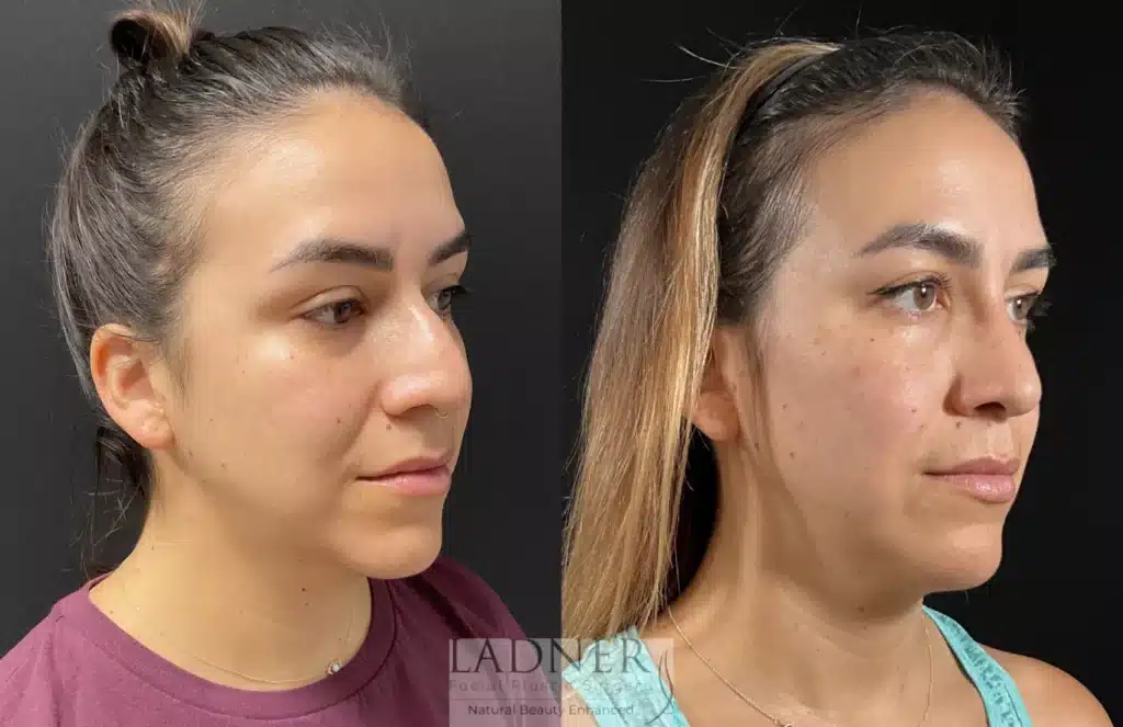 Before and After Image: Rhinoplasty - right-front-oblique