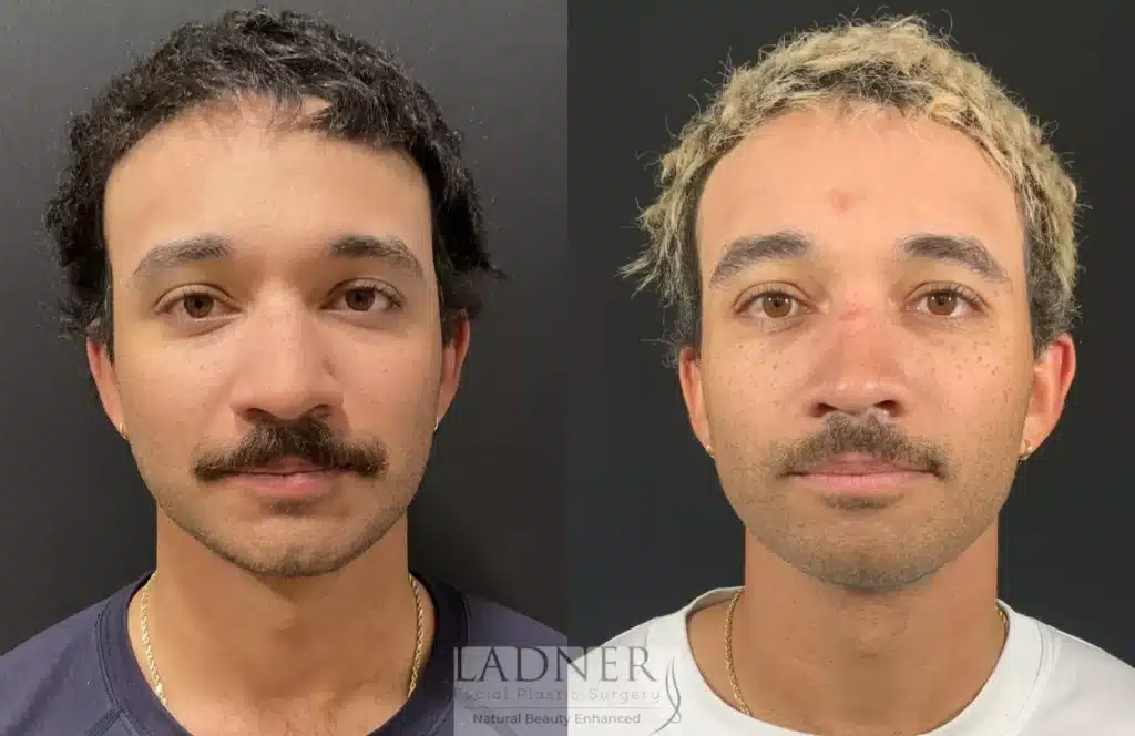 Before and After Image: Rhinoplasty - front