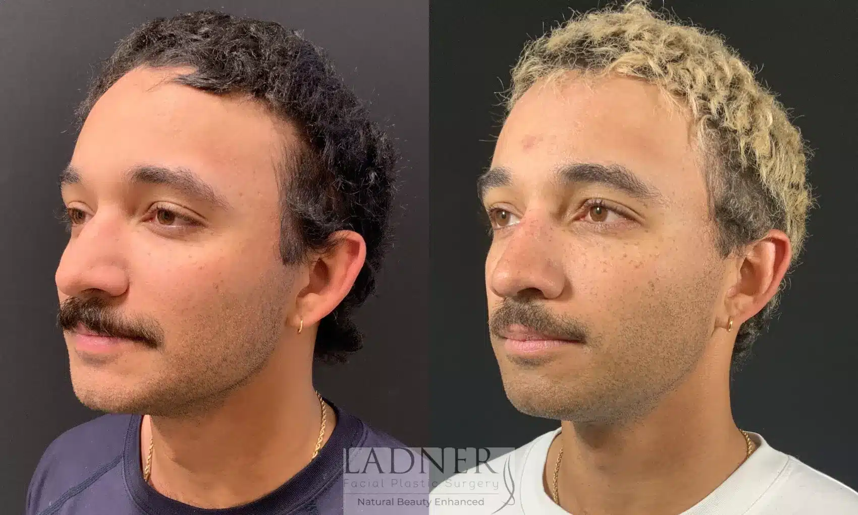Before and After Image: Rhinoplasty - left-front-oblique